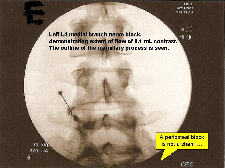 Left L 4 medial branch nerve block, demonstrating extent of flow of 0. 1