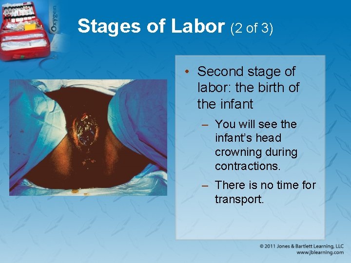 Stages of Labor (2 of 3) • Second stage of labor: the birth of
