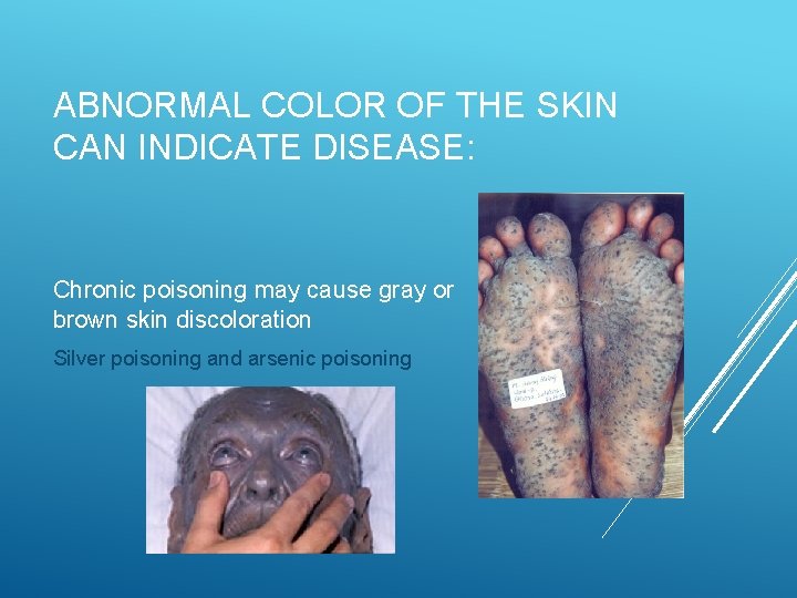ABNORMAL COLOR OF THE SKIN CAN INDICATE DISEASE: Chronic poisoning may cause gray or