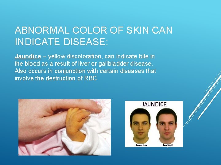ABNORMAL COLOR OF SKIN CAN INDICATE DISEASE: Jaundice – yellow discoloration, can indicate bile