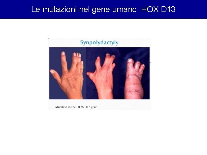 Le mutazioni nel gene umano HOX D 13 