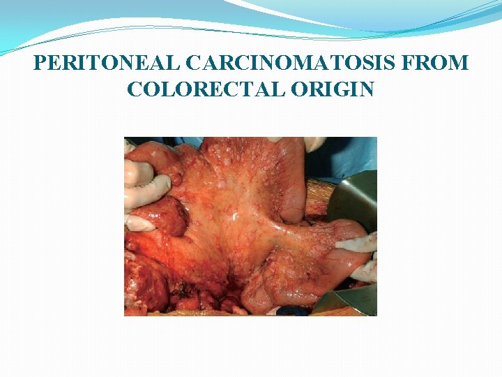 PERITONEAL CARCINOMATOSIS FROM COLORECTAL ORIGIN 