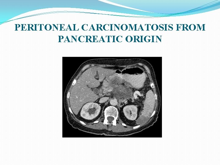 PERITONEAL CARCINOMATOSIS FROM PANCREATIC ORIGIN 