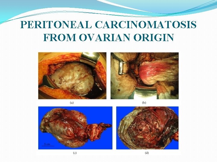 PERITONEAL CARCINOMATOSIS FROM OVARIAN ORIGIN 