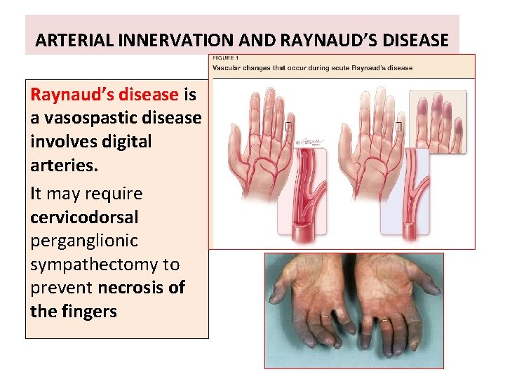 ARTERIAL INNERVATION AND RAYNAUD’S DISEASE Raynaud’s disease is a vasospastic disease involves digital arteries.