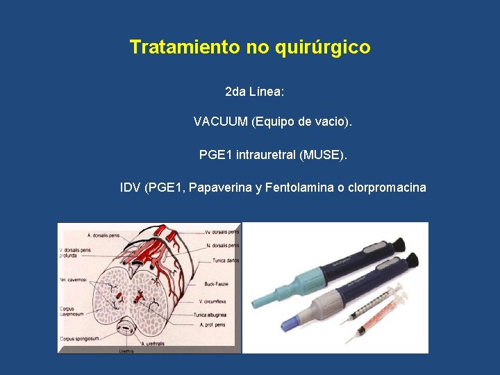 Tratamiento no quirúrgico 2 da Línea: VACUUM (Equipo de vacio). PGE 1 intrauretral (MUSE).
