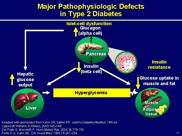 Major Pathophysiologic Defects in Type 2 Diabetes Islet-cell dysfunction Glucagon (alpha cell) Pancreas Hepatic