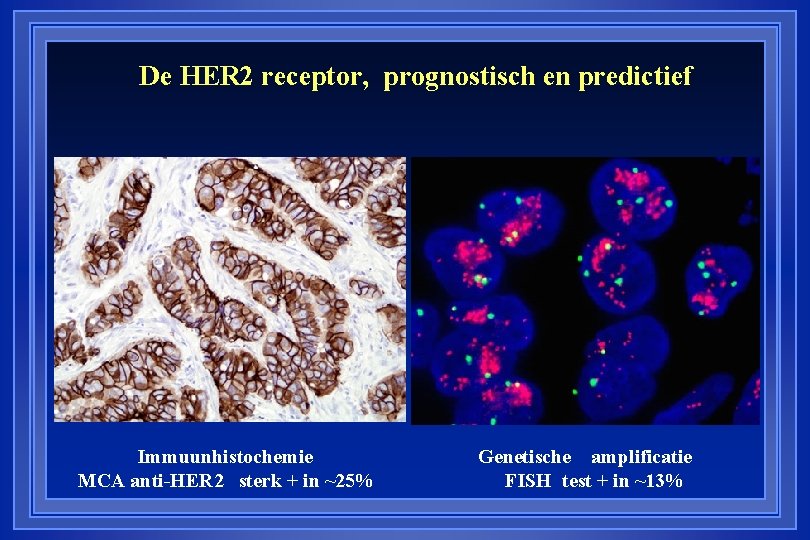 De HER 2 receptor, prognostisch en predictief Immuunhistochemie MCA anti-HER 2 sterk + in