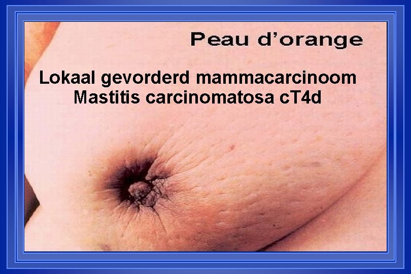 Lokaal gevorderd mammacarcinoom Mastitis carcinomatosa c. T 4 d 