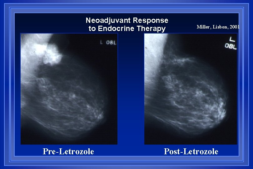 Neoadjuvant Response to Endocrine Therapy Pre-Letrozole Miller, Lisbon, 2001 Post-Letrozole 