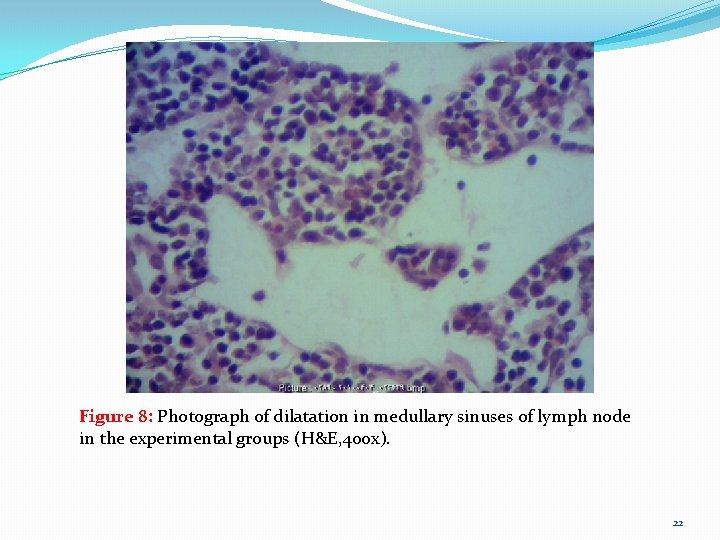 Figure 8: Photograph of dilatation in medullary sinuses of lymph node in the experimental