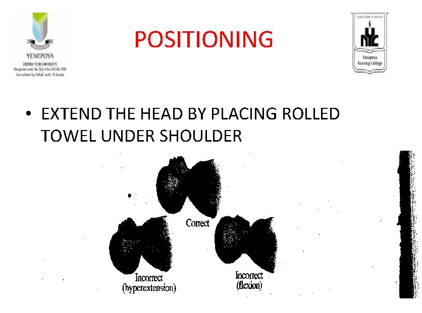 POSITIONING • EXTEND THE HEAD BY PLACING ROLLED TOWEL UNDER SHOULDER 