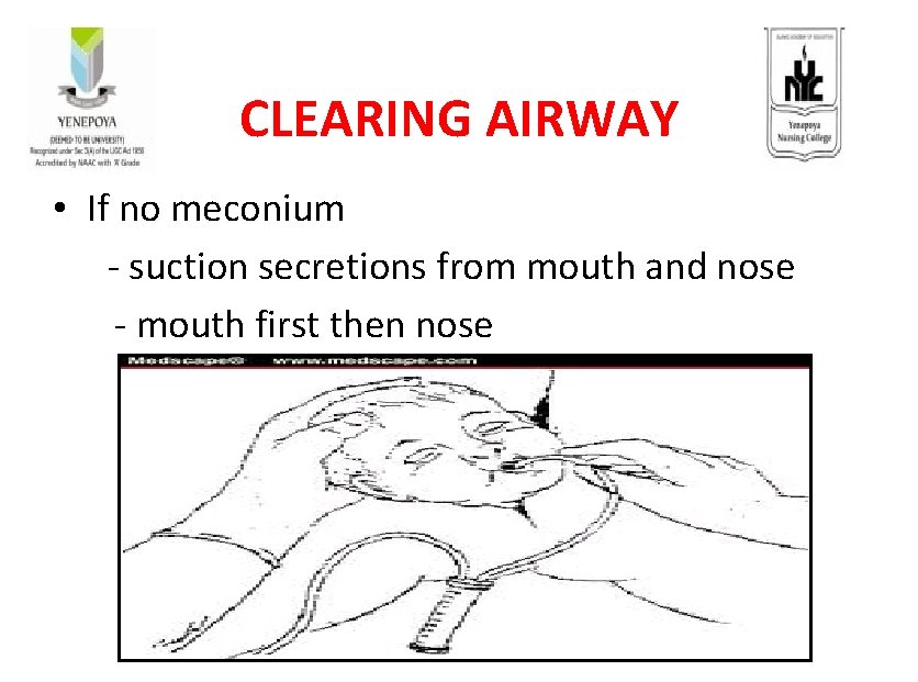 CLEARING AIRWAY • If no meconium - suction secretions from mouth and nose -
