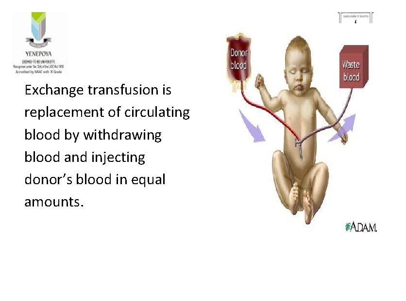 Exchange transfusion is replacement of circulating blood by withdrawing blood and injecting donor’s blood