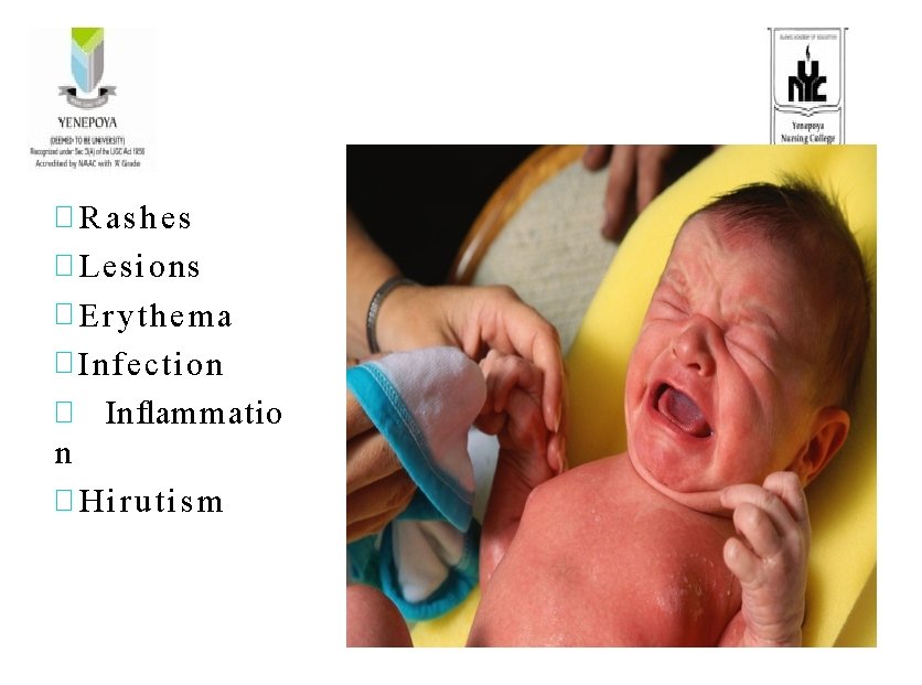 � Rashes � Lesions � Erythema � Infection � Inflammatio n � Hirutism 