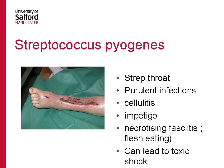 Streptococcus pyogenes • • • Strep throat Purulent infections cellulitis impetigo necrotising fasciitis (