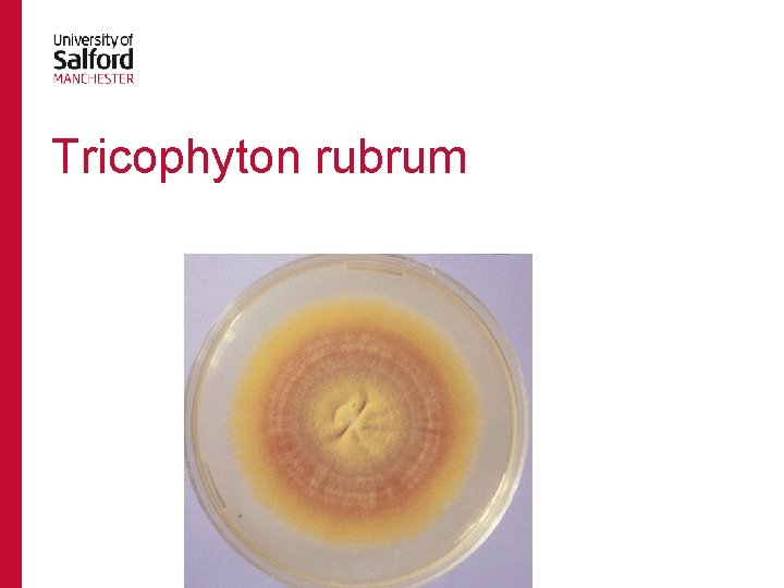 Tricophyton rubrum 
