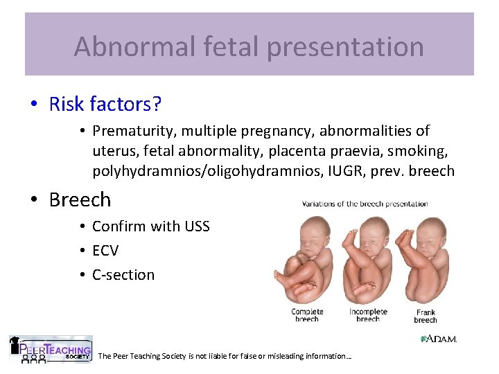 Abnormal fetal presentation • Risk factors? • Prematurity, multiple pregnancy, abnormalities of uterus, fetal