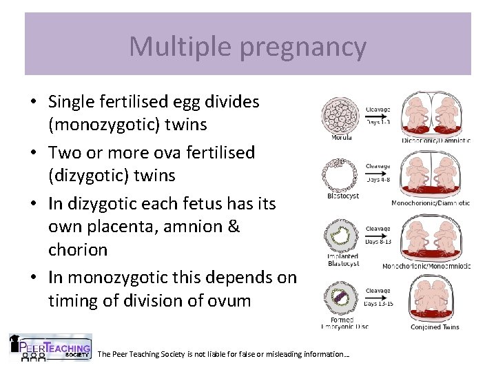 Multiple pregnancy • Single fertilised egg divides (monozygotic) twins • Two or more ova