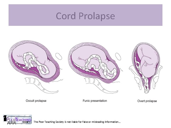 Cord Prolapse The Peer Teaching Society is not liable for false or misleading information…