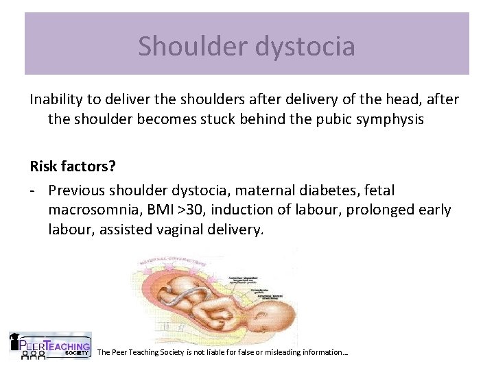 Shoulder dystocia Inability to deliver the shoulders after delivery of the head, after the