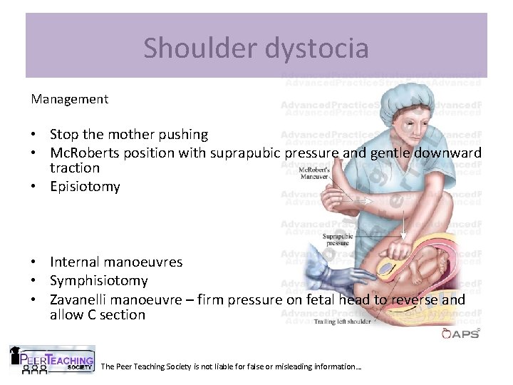 Shoulder dystocia Management • Stop the mother pushing • Mc. Roberts position with suprapubic