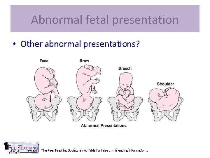 Abnormal fetal presentation • Other abnormal presentations? The Peer Teaching Society is not liable