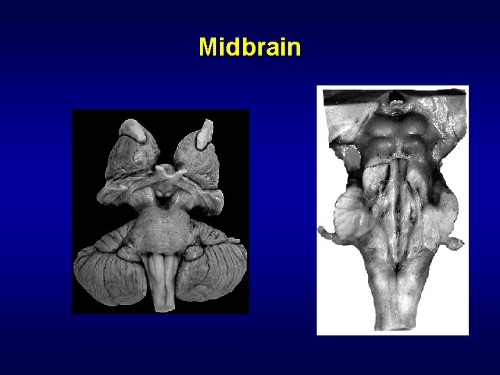 Midbrain 