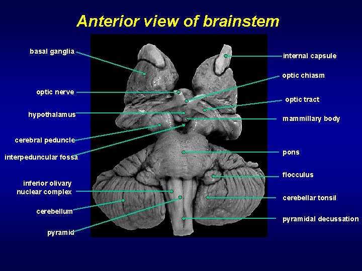 Anterior view of brainstem basal ganglia internal capsule optic chiasm optic nerve hypothalamus optic