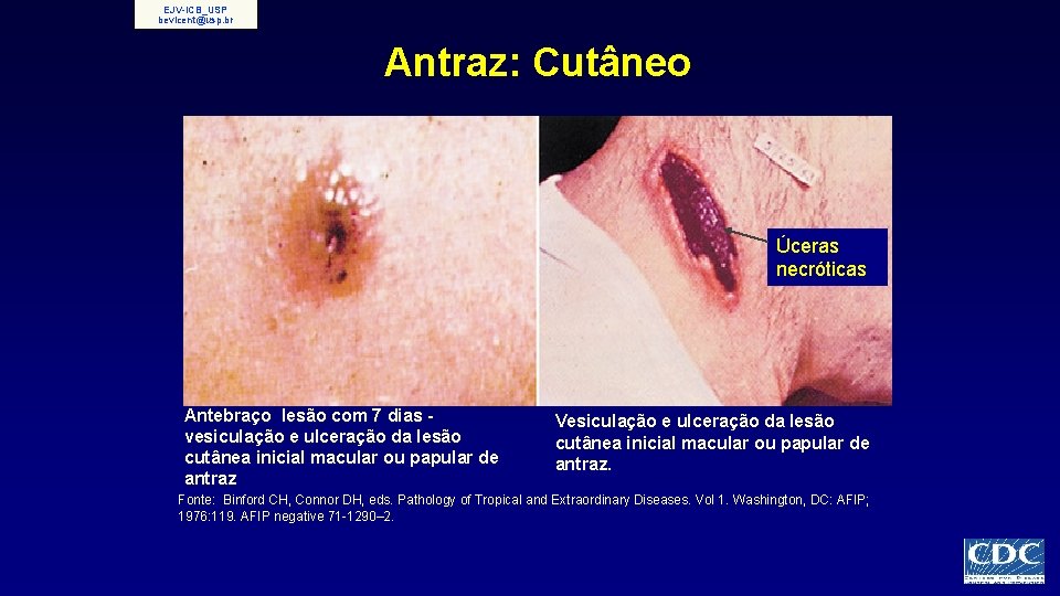 EJV-ICB_USP bevicent@usp. br Antraz: Cutâneo Úceras necróticas Antebraço lesão com 7 dias vesiculação e