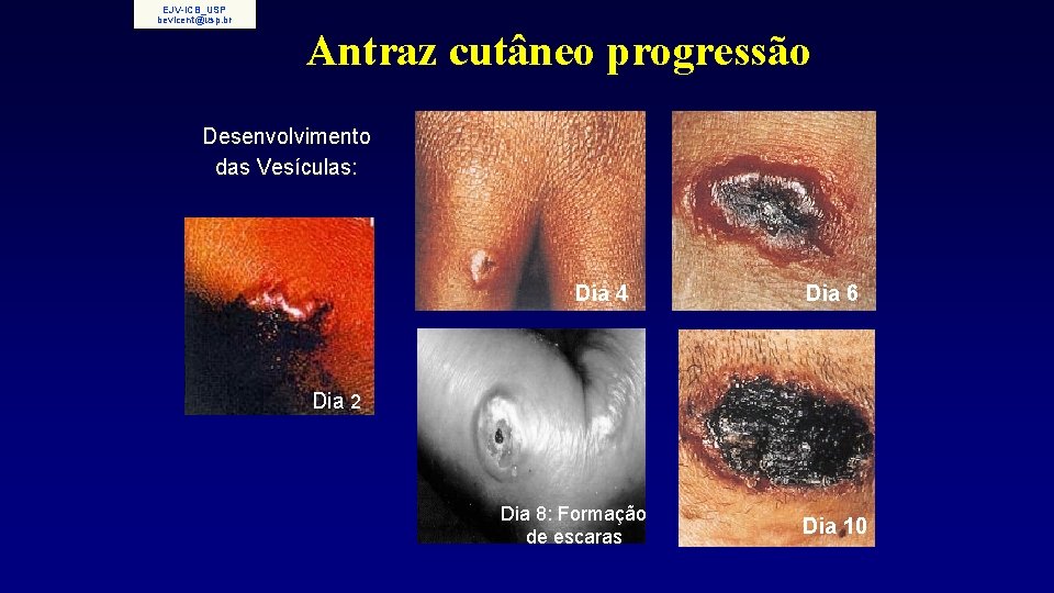 EJV-ICB_USP bevicent@usp. br Antraz cutâneo progressão Desenvolvimento das Vesículas: Dia 4 Dia 6 Dia