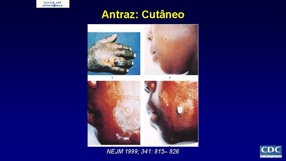 EJV-ICB_USP bevicent@usp. br Antraz: Cutâneo NEJM 1999; 341: 815– 826 