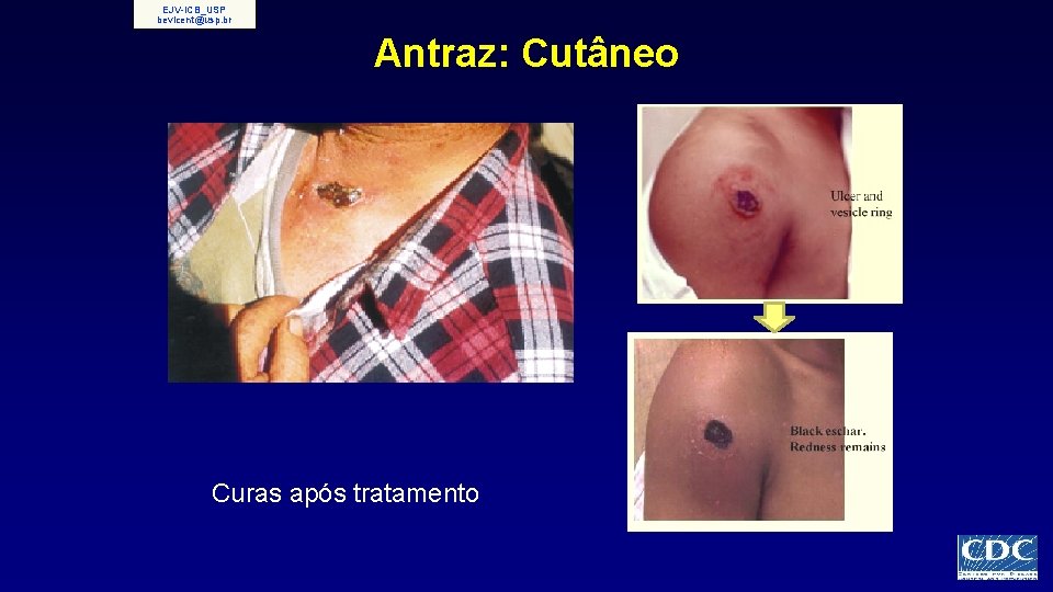 EJV-ICB_USP bevicent@usp. br Antraz: Cutâneo Curas após tratamento 