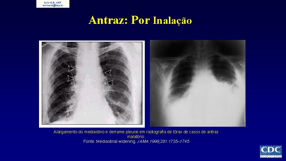 EJV-ICB_USP bevicent@usp. br Antraz: Por Inalação Alargamento do mediastino e derrame pleural em radiografia