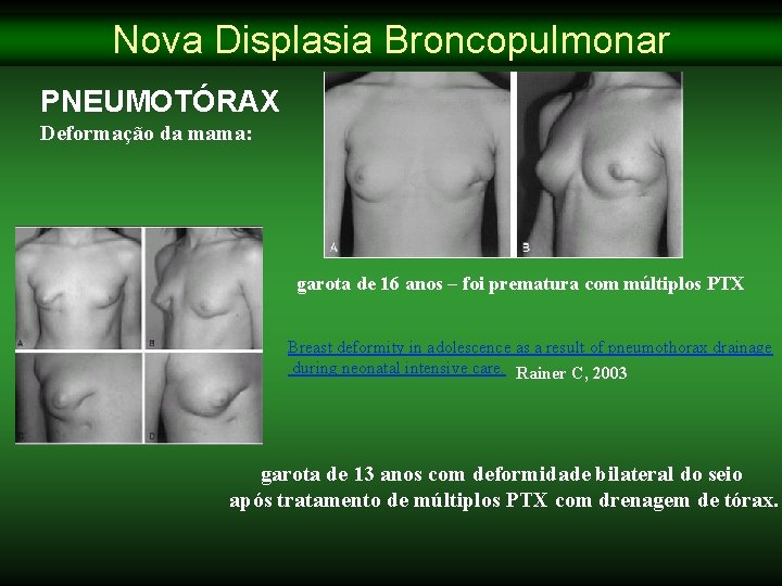 Nova Displasia Broncopulmonar PNEUMOTÓRAX Deformação da mama: garota de 16 anos – foi prematura