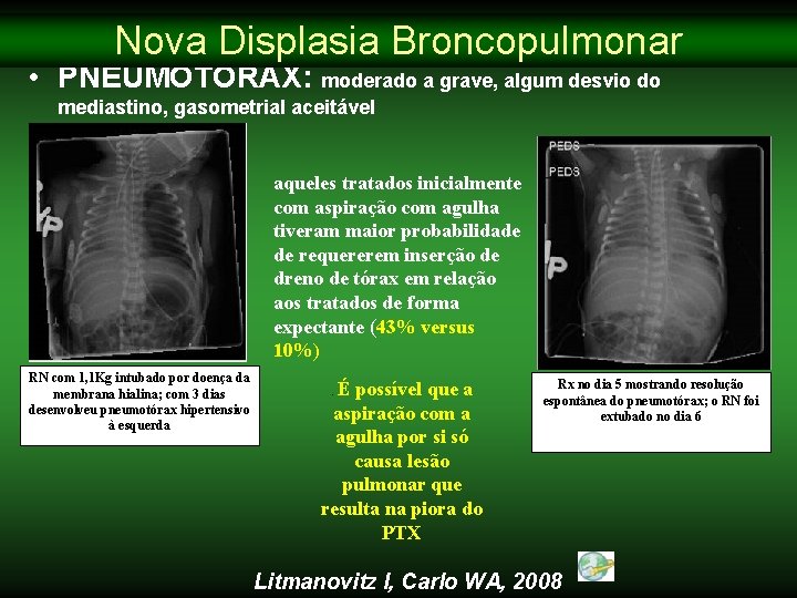 Nova Displasia Broncopulmonar • PNEUMOTÓRAX: moderado a grave, algum desvio do mediastino, gasometrial aceitável