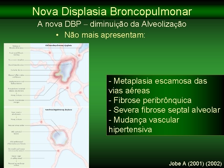 Nova Displasia Broncopulmonar A nova DBP – diminuição da Alveolização • Não mais apresentam: