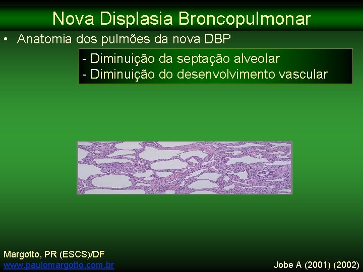 Nova Displasia Broncopulmonar • Anatomia dos pulmões da nova DBP - Diminuição da septação