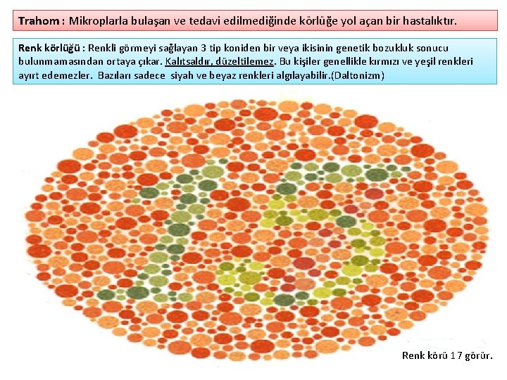 Trahom : Mikroplarla bulaşan ve tedavi edilmediğinde körlüğe yol açan bir hastalıktır. Renk körlüğü