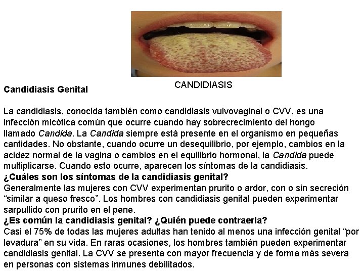 Candidiasis Genital CANDIDIASIS La candidiasis, conocida también como candidiasis vulvovaginal o CVV, es una