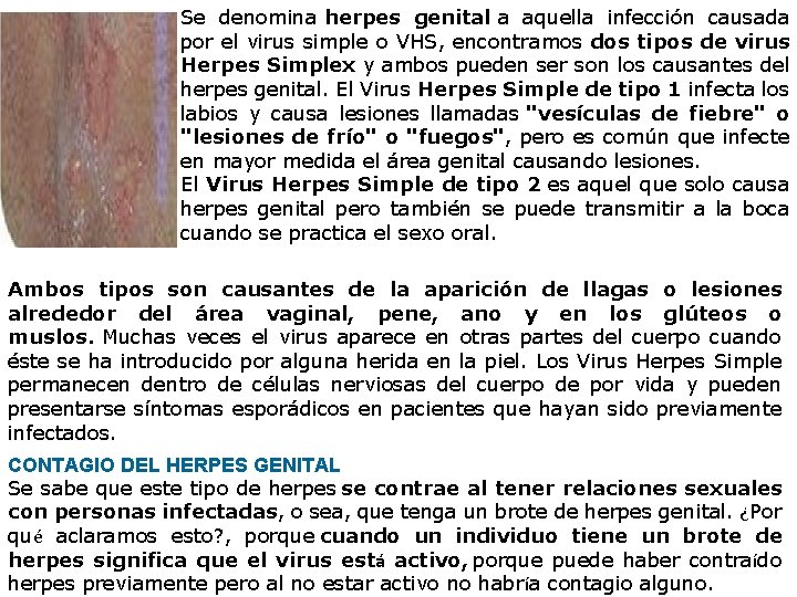 Se denomina herpes genital a aquella infección causada por el virus simple o VHS,