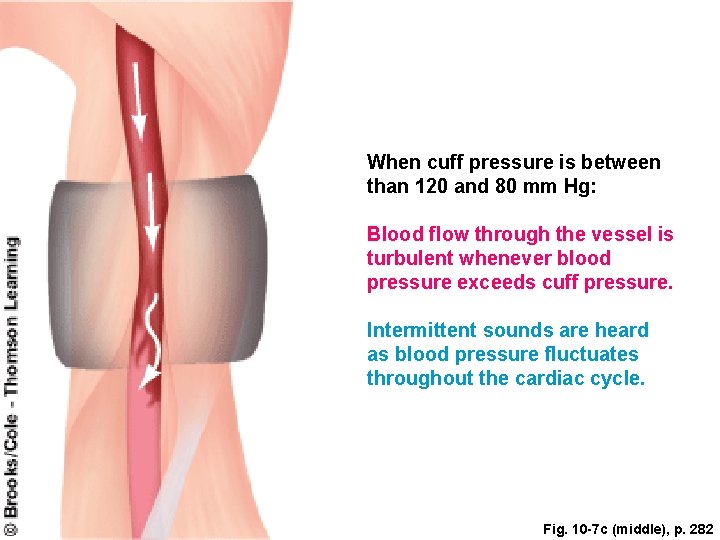 When cuff pressure is between than 120 and 80 mm Hg: Blood flow through When cuff pressure is between than 120 and 80 mm Hg: Blood flow through