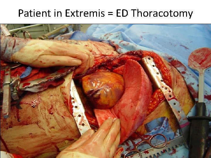 Patient in Extremis = ED Thoracotomy 