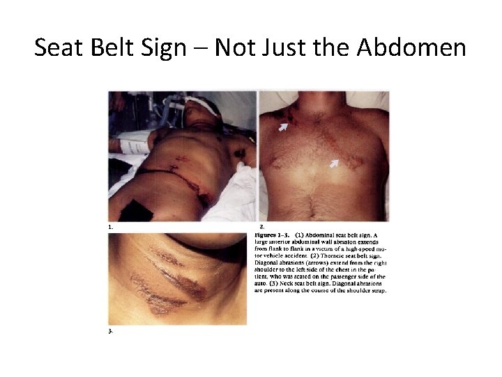 Seat Belt Sign – Not Just the Abdomen 