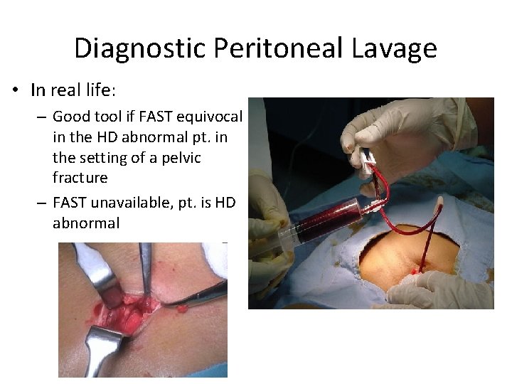 Diagnostic Peritoneal Lavage • In real life: – Good tool if FAST equivocal in