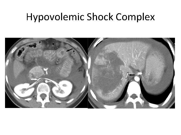 Hypovolemic Shock Complex 
