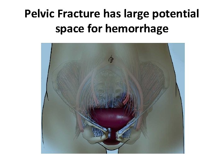 Pelvic Fracture has large potential space for hemorrhage 