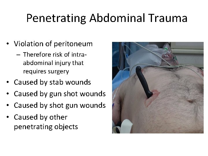 Penetrating Abdominal Trauma • Violation of peritoneum – Therefore risk of intraabdominal injury that