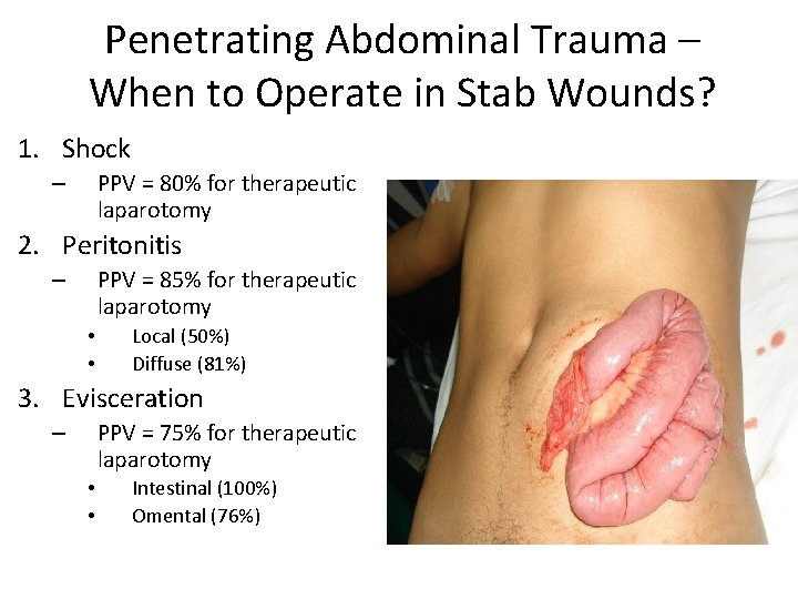 Penetrating Abdominal Trauma – When to Operate in Stab Wounds? 1. Shock PPV =