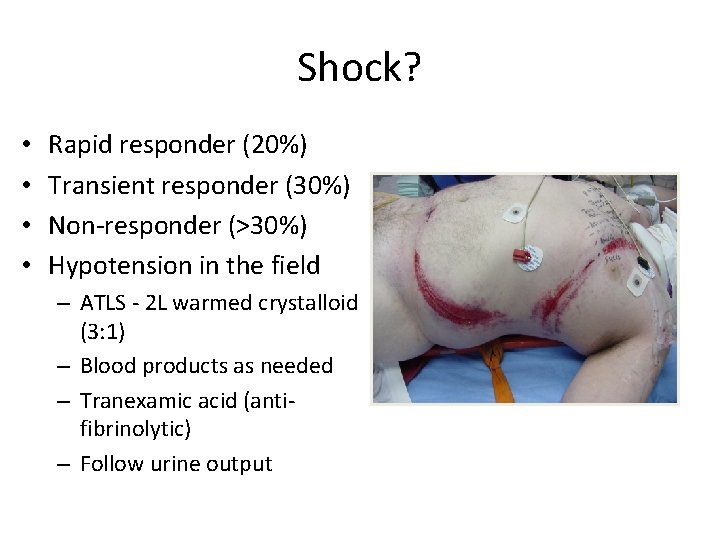 Shock? • • Rapid responder (20%) Transient responder (30%) Non-responder (>30%) Hypotension in the